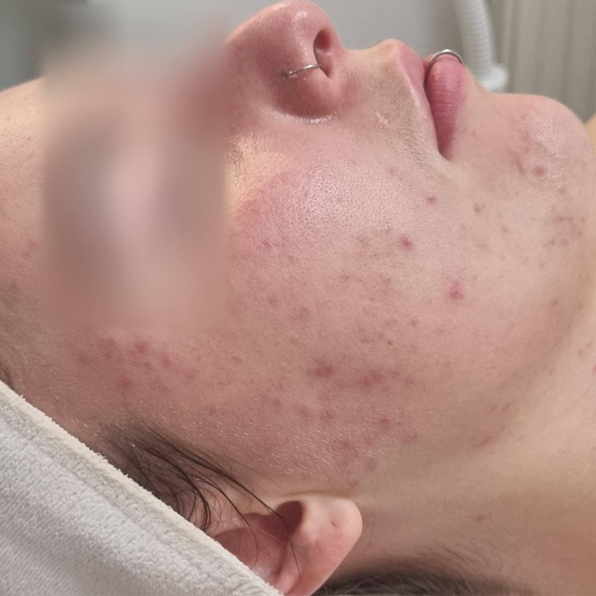 ELSŐ KEZELÉS ELŐTT